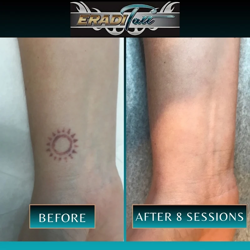 EradiTatt Tattoo Removal of St. Petersburg