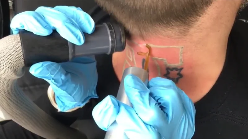 Removery Tattoo Removal & Fading photo 2