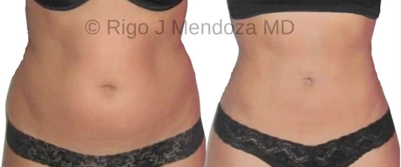 Dr Rigo Mendoza - Tampa Plastic Surgeon photo 3