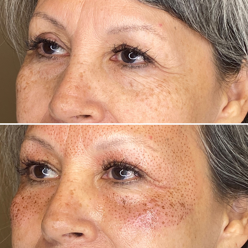 Eternal Youth Plasma Skin Tightening Therapy