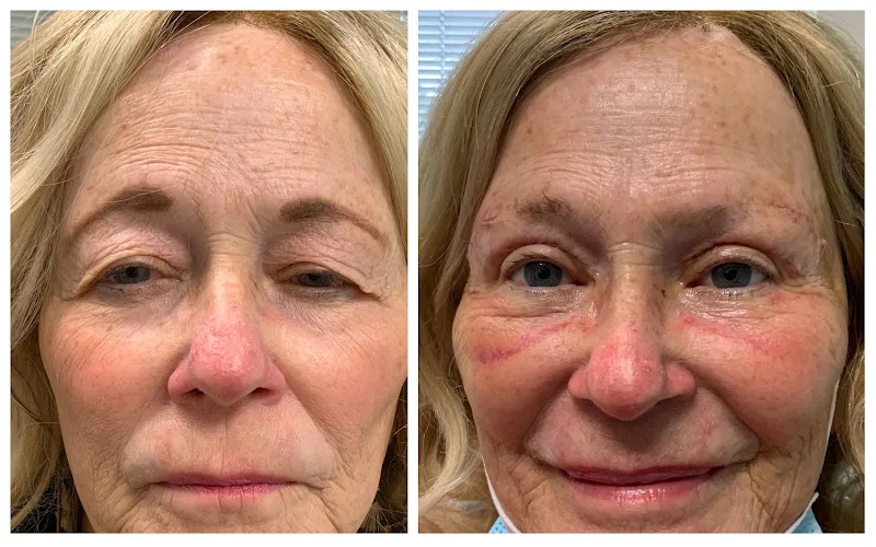 Eyelid Surgeons of Tampa Bay